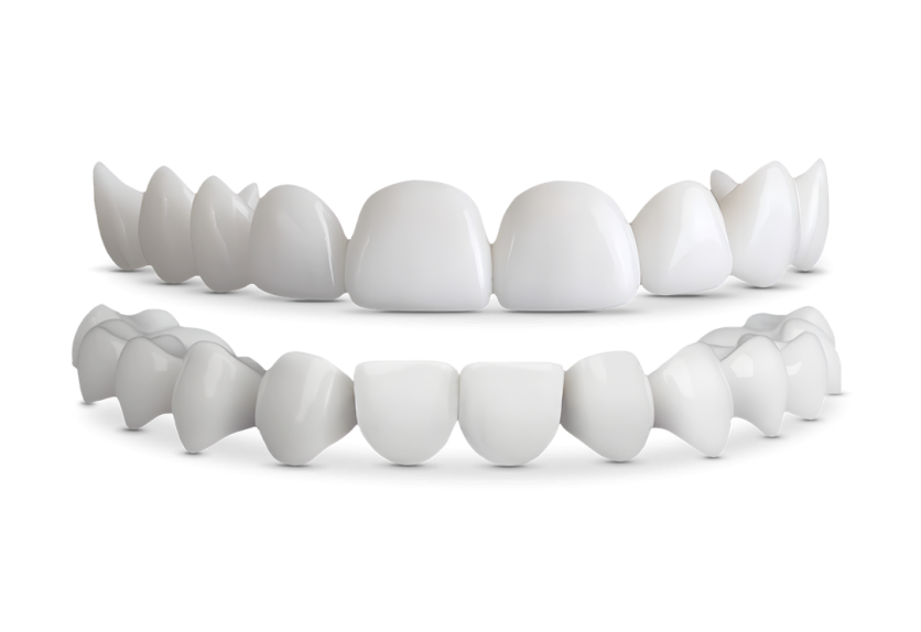 Shiny Smile Veneers