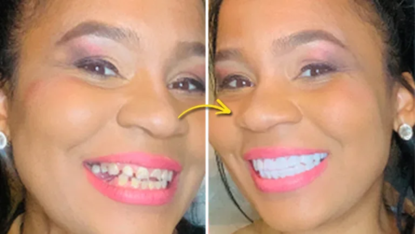 Shiny Smile Veneers