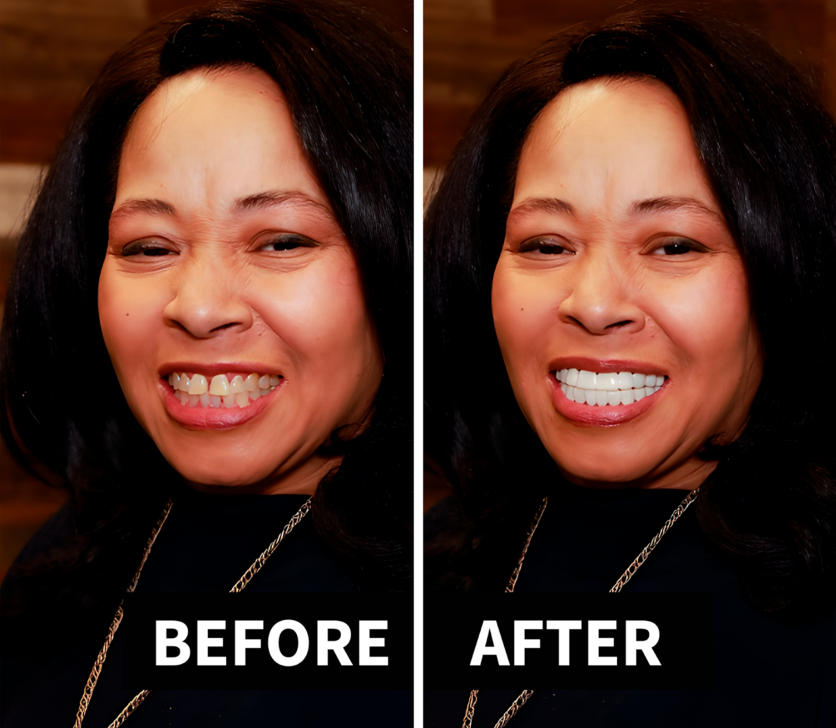 Shiny Smile Veneers