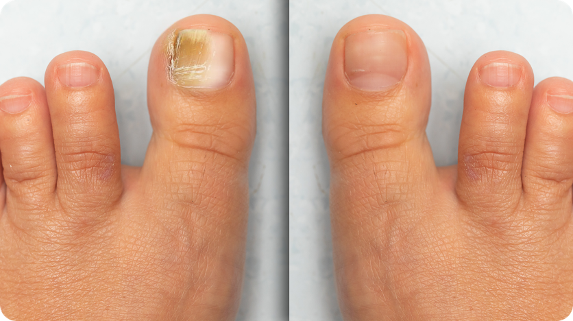 Fungabeam Toenail Fungus Device