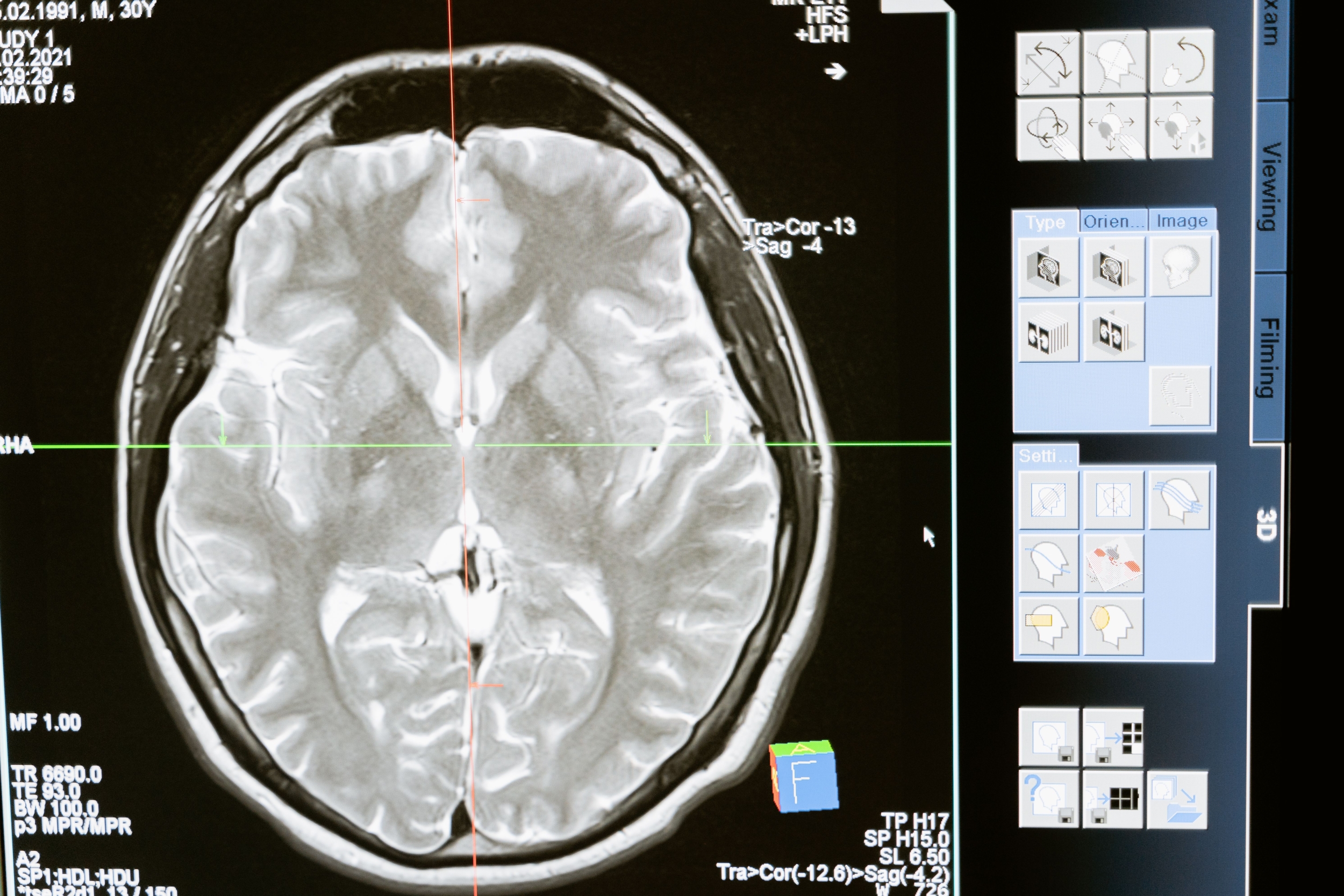 Brain Uses Memory Ripples to Brace Vision for Surprise: First Direct Human Evidence