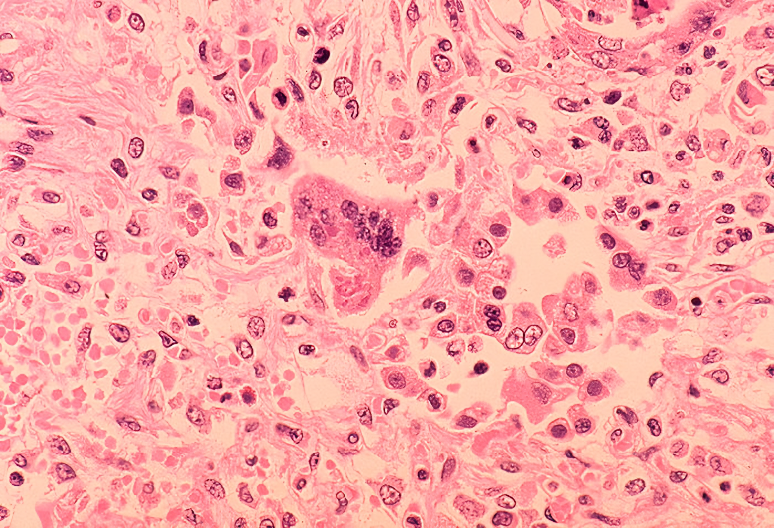Measles Outbreak Nears 30-Year US Record as Virginia Becomes New Hot Spot