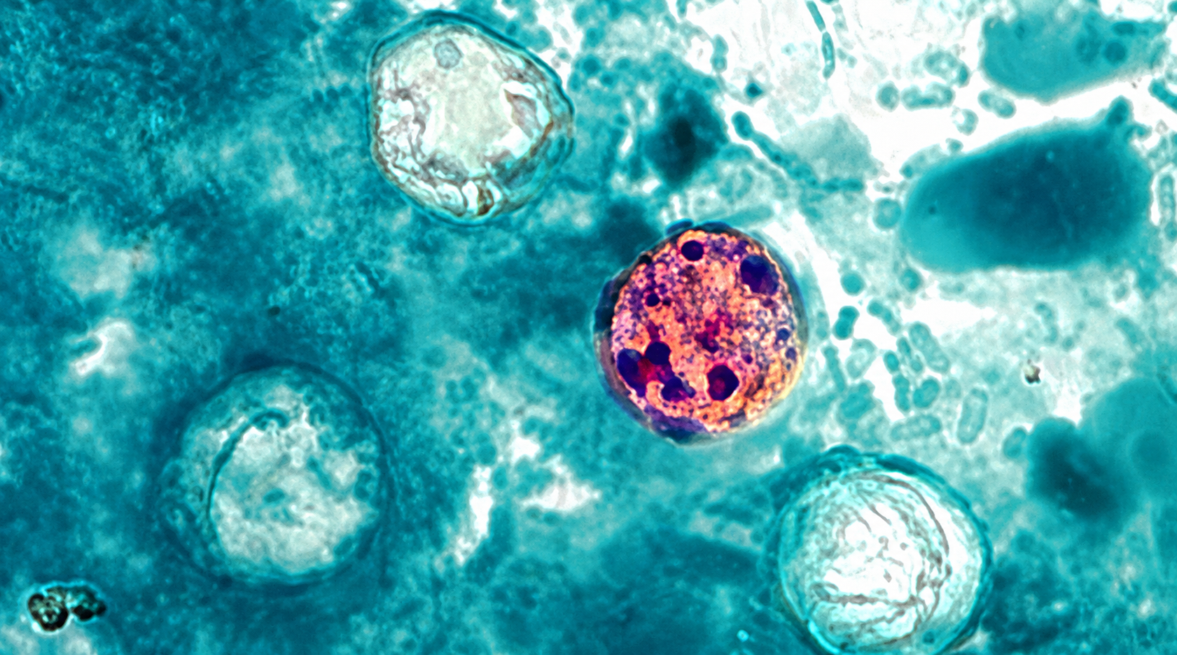 Cyclospora Tops 4,000 Cases in 31 States: Washing Produce Won't Kill This Parasite