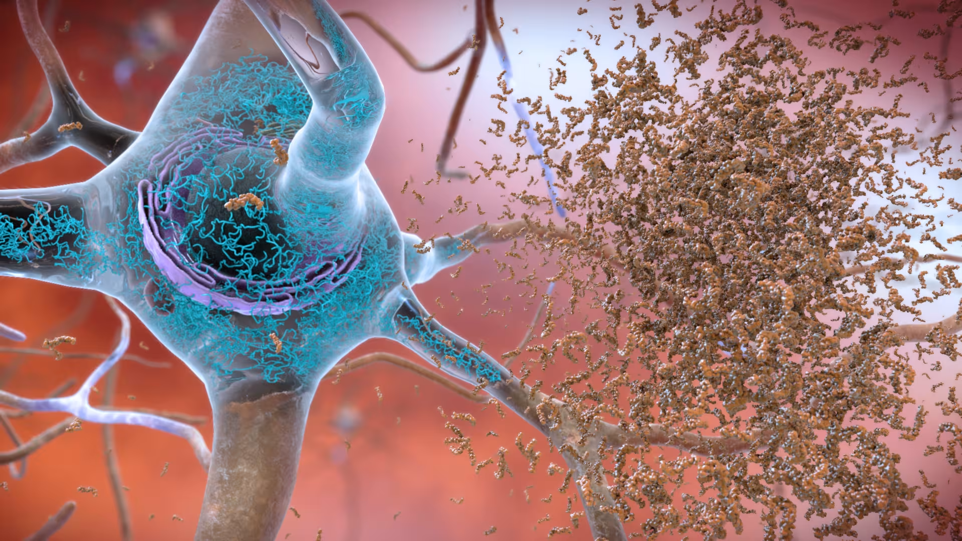 PMN310 Cuts Alzheimer Oligomers in Humans, Dodging Side Effects That Limit Rival Drugs
